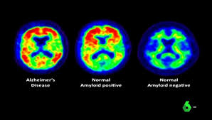 Portada post Un biomarcador en sangre detecta el Alzheimer en personas con síndrome de Down